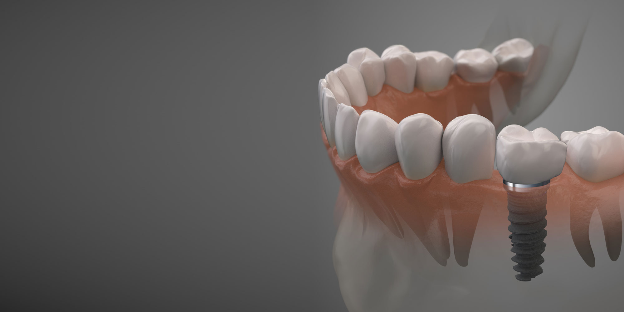 Dental Implants in Murrieta, CA