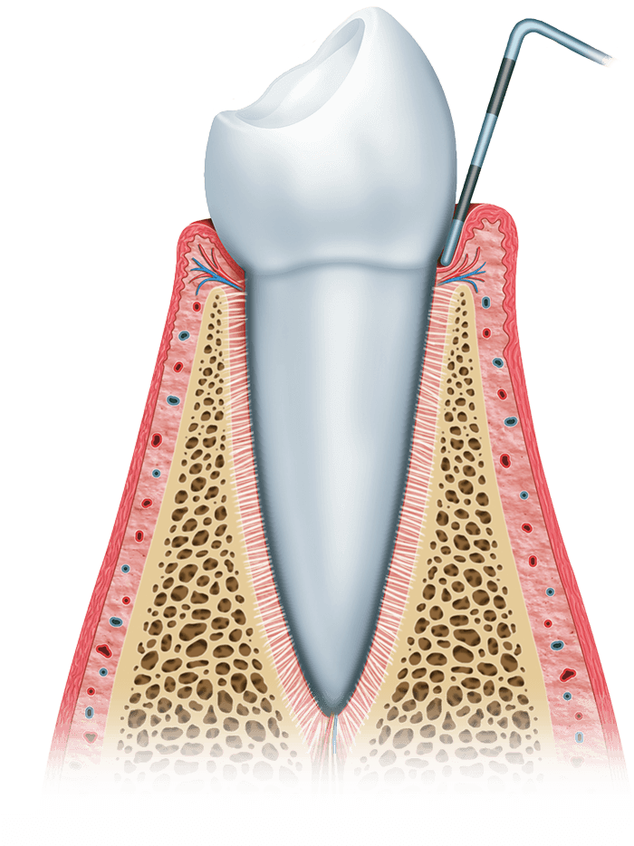 gum disease stage 1