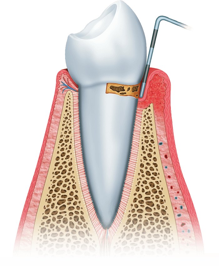gum disease stage 2